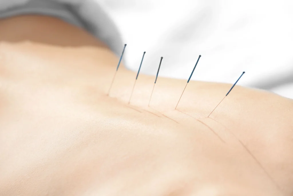 acupuncture singapore