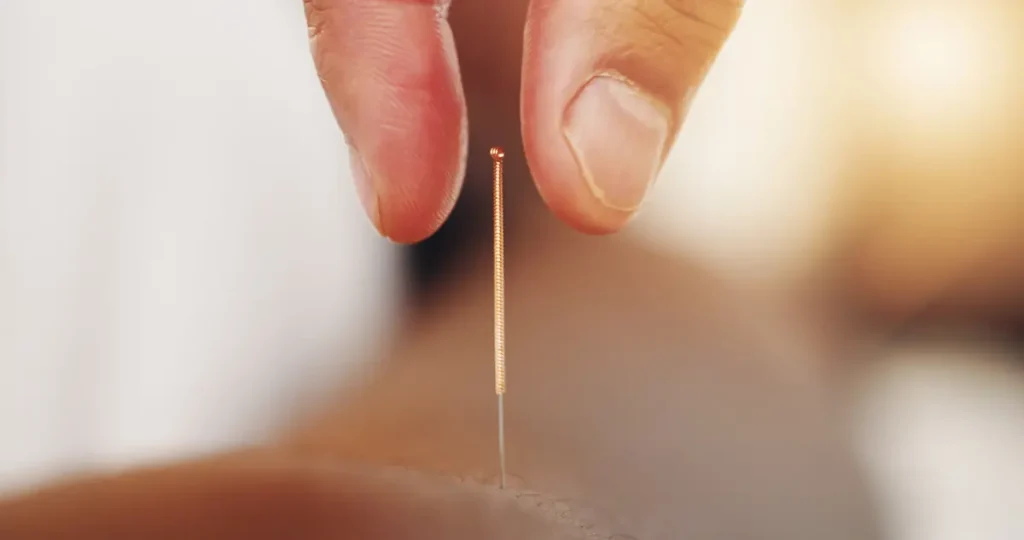 a close-up shot of a finger about to get an acupuncture needle during a treatment in Singapore