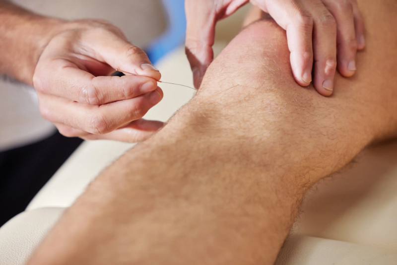 a needle being inserted into the knee to treat a physical injury through acupuncture treatment in Singapore