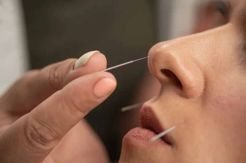 an adult patient in Singapore receiving an acupuncture treatment around her nose